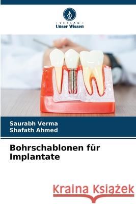 Bohrschablonen f?r Implantate Saurabh Verma Shafath Ahmed 9786207663651 Verlag Unser Wissen