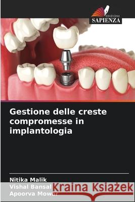 Gestione delle creste compromesse in implantologia Nitika Malik Vishal Bansal Apoorva Mowar 9786207690909 Edizioni Sapienza