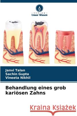 Behandlung eines grob kari?sen Zahns Janvi Talan Sachin Gupta Vineeta Nikhil 9786207766789