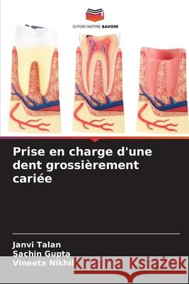 Prise en charge d'une dent grossi?rement cari?e Janvi Talan Sachin Gupta Vineeta Nikhil 9786207766802 Editions Notre Savoir