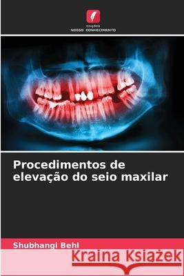 Procedimentos de eleva??o do seio maxilar Shubhangi Behl 9786207800285 Edicoes Nosso Conhecimento