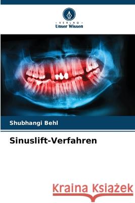 Sinuslift-Verfahren Shubhangi Behl 9786207800308 Verlag Unser Wissen