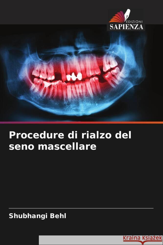 Procedure di rialzo del seno mascellare Behl, Shubhangi 9786207800339