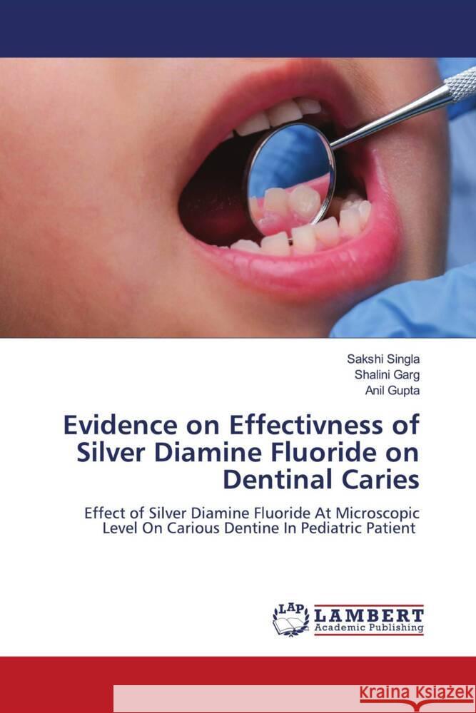 Evidence on Effectivness of Silver Diamine Fluoride on Dentinal Caries Sakshi Singla Shalini Garg Anil Gupta 9786207841660