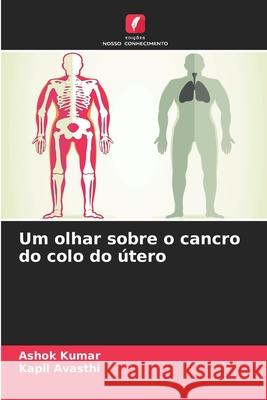 Um olhar sobre o cancro do colo do ?tero Ashok Kumar Kapil Avasthi 9786207863181