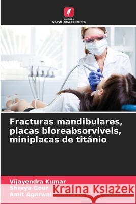 Fracturas mandibulares, placas bioreabsorv?veis, miniplacas de tit?nio Vijayendra Kumar Shreya Gour Amit Agarwal 9786207891269 Edicoes Nosso Conhecimento