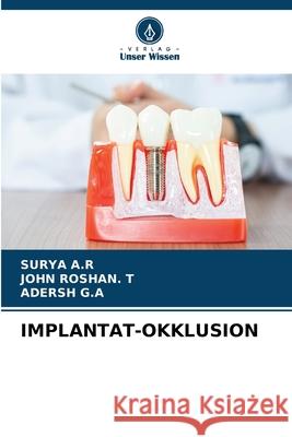 Implantat-Okklusion Surya A John Rosha Adersh G 9786207931637