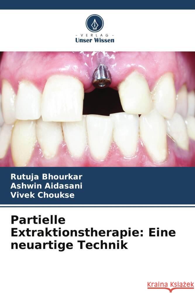 Partielle Extraktionstherapie: Eine neuartige Technik Rutuja Bhourkar Ashwin Aidasani Vivek Choukse 9786207972425