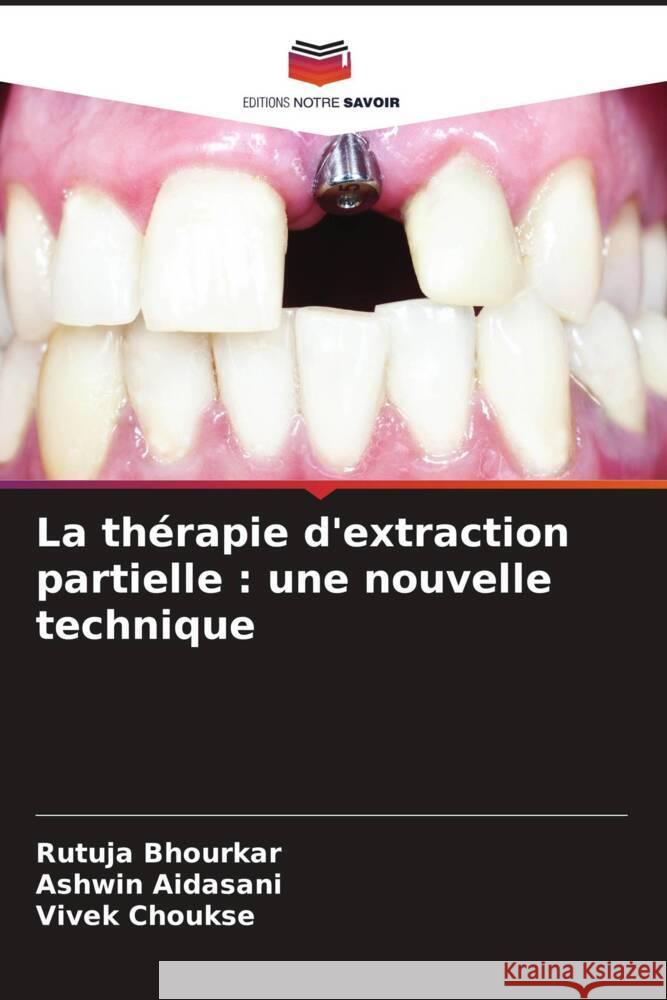 La th?rapie d'extraction partielle: une nouvelle technique Rutuja Bhourkar Ashwin Aidasani Vivek Choukse 9786207972449