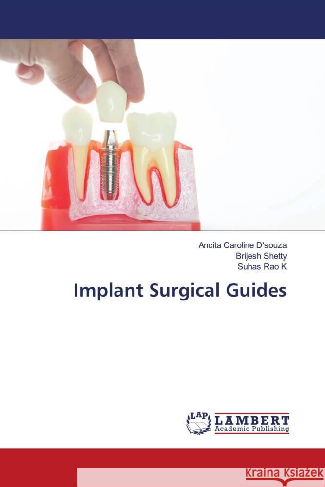 Implant Surgical Guides Ancita Caroline D'Souza Brijesh Shetty Suhas Rao K 9786208009618