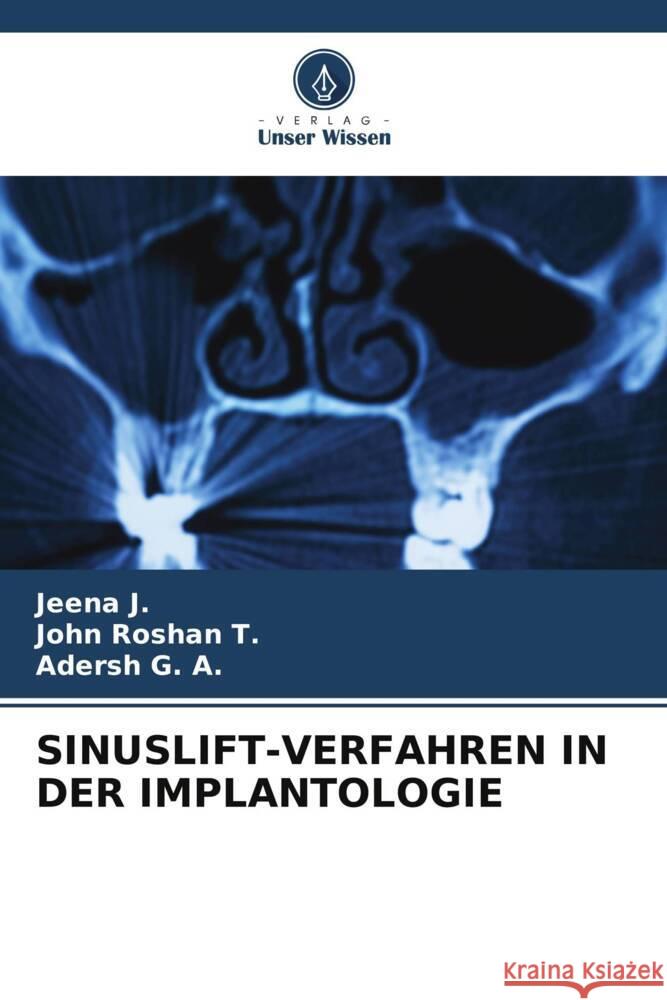 Sinuslift-Verfahren in Der Implantologie Jeena J John Rosha Adersh G 9786208015350