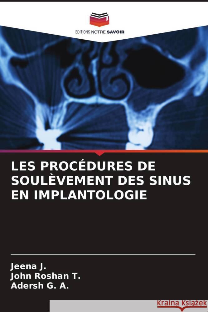 Les Proc?dures de Soul?vement Des Sinus En Implantologie Jeena J John Rosha Adersh G 9786208015497 Editions Notre Savoir