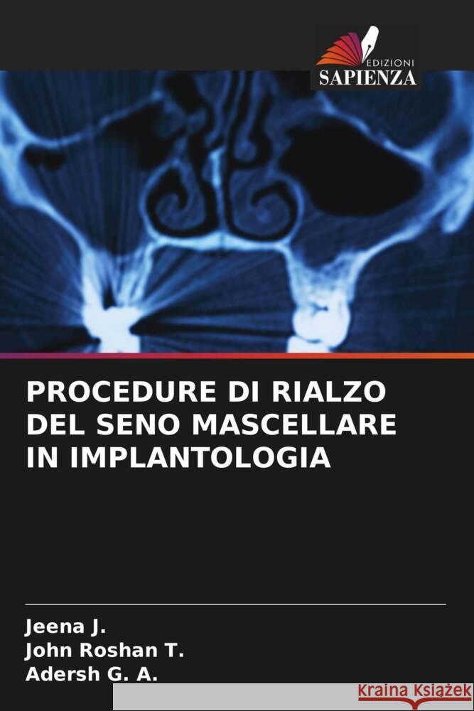 Procedure Di Rialzo del Seno Mascellare in Implantologia Jeena J John Rosha Adersh G 9786208015527 Edizioni Sapienza