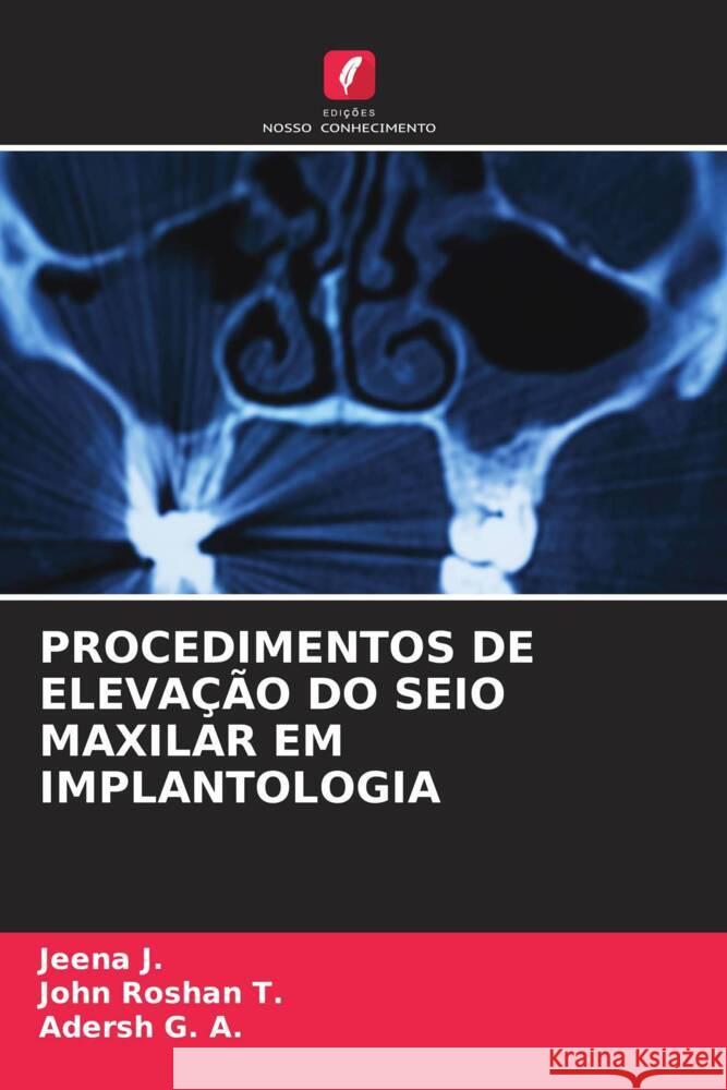 Procedimentos de Eleva??o Do Seio Maxilar Em Implantologia Jeena J John Rosha Adersh G 9786208015558