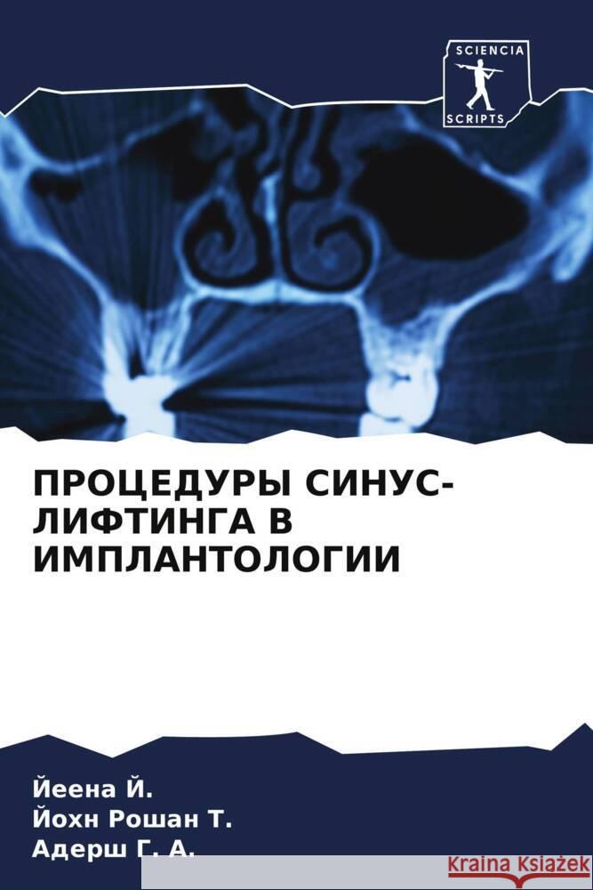 PROCEDURY SINUS-LIFTINGA V IMPLANTOLOGII J., Jeena, Roshan T., John, G. A., Adersh 9786208015572