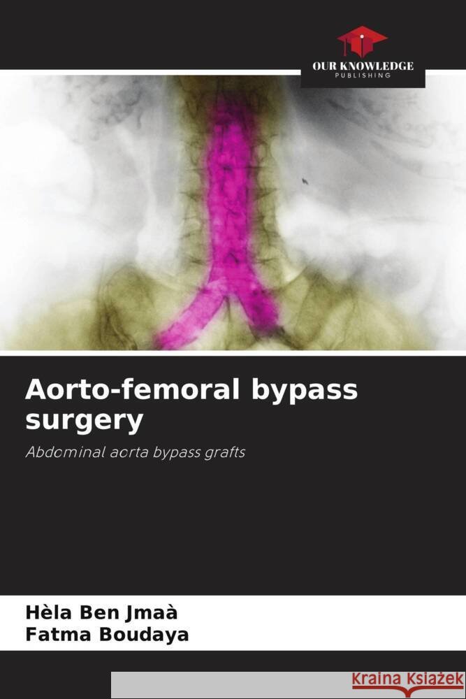 Aorto-femoral bypass surgery H?la Be Fatma Boudaya 9786208042196 Our Knowledge Publishing