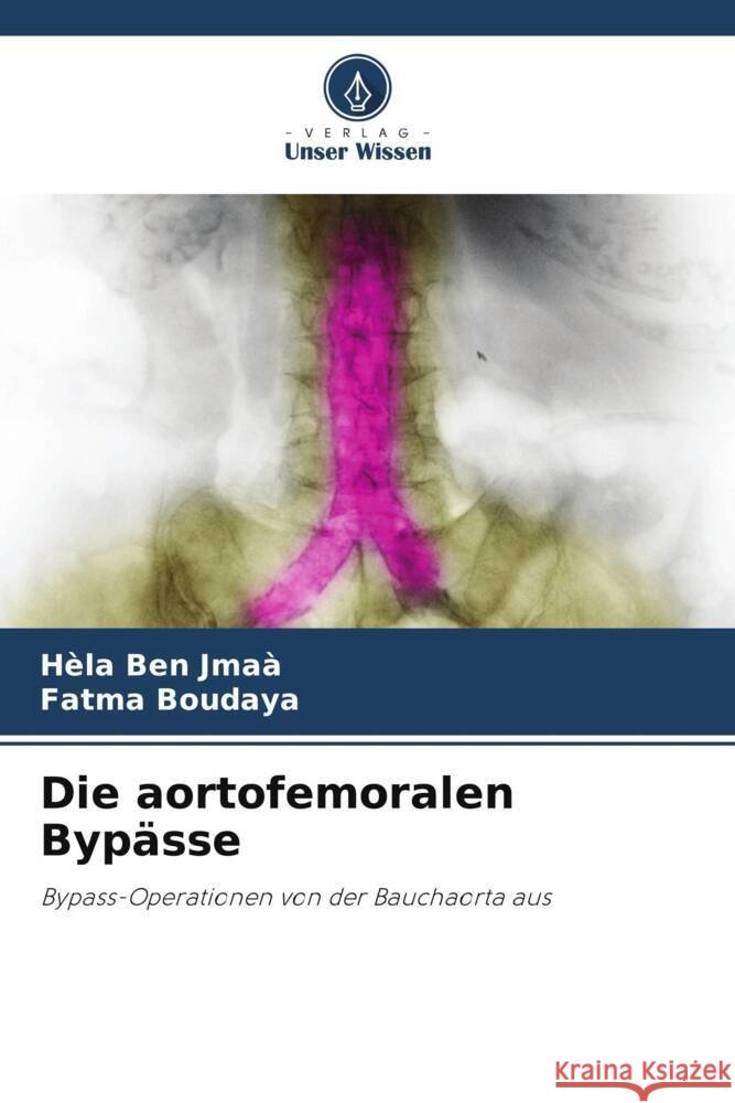 Die aortofemoralen Byp?sse H?la Be Fatma Boudaya 9786208042202 Verlag Unser Wissen