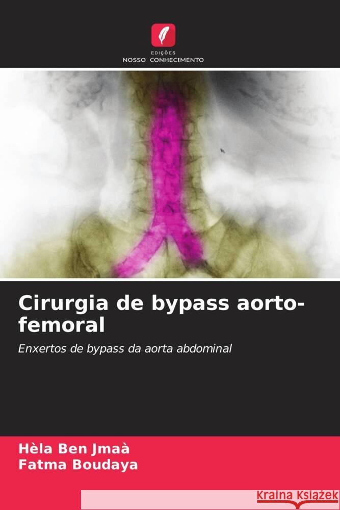 Cirurgia de bypass aorto-femoral H?la Be Fatma Boudaya 9786208042226 Edicoes Nosso Conhecimento