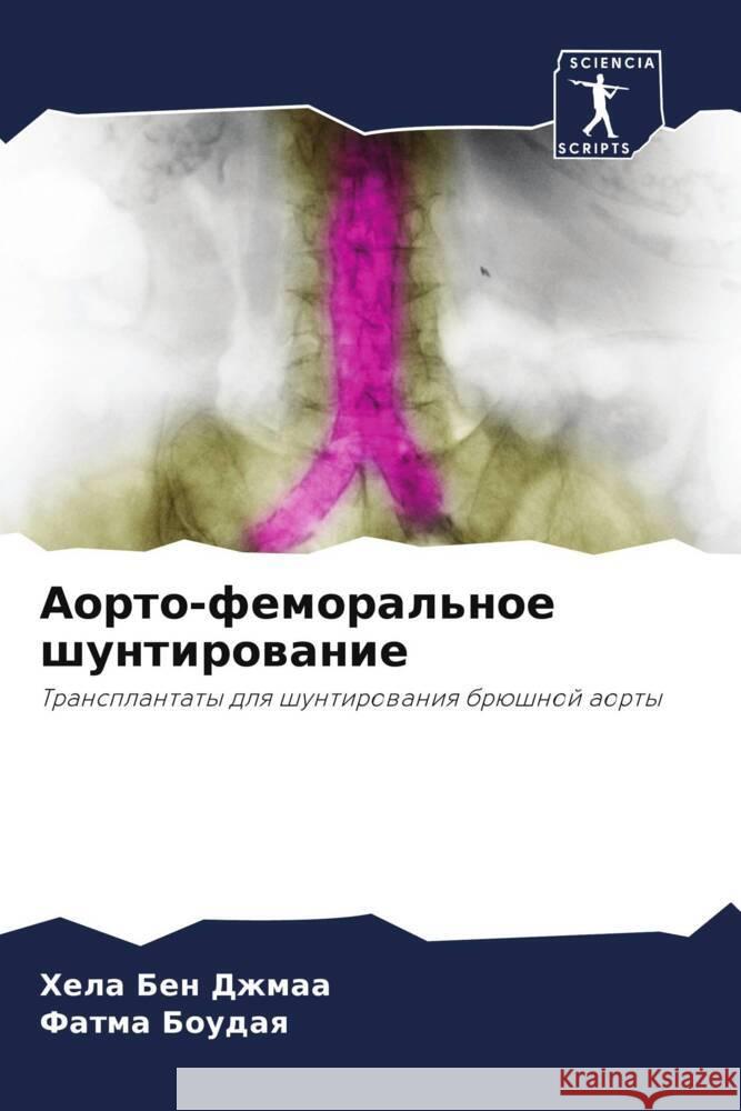 Aorto-femoral'noe shuntirowanie Ben Dzhmaa, Hela, Boudaq, Fatma 9786208042233 Sciencia Scripts