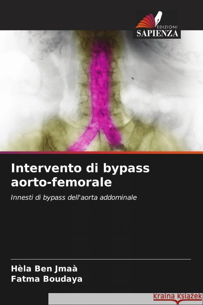 Intervento di bypass aorto-femorale H?la Be Fatma Boudaya 9786208042240 Edizioni Sapienza