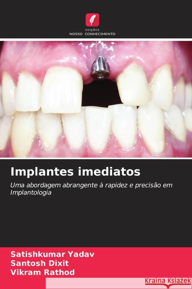 Implantes imediatos Satishkumar Yadav Santosh Dixit Vikram Rathod 9786208060442