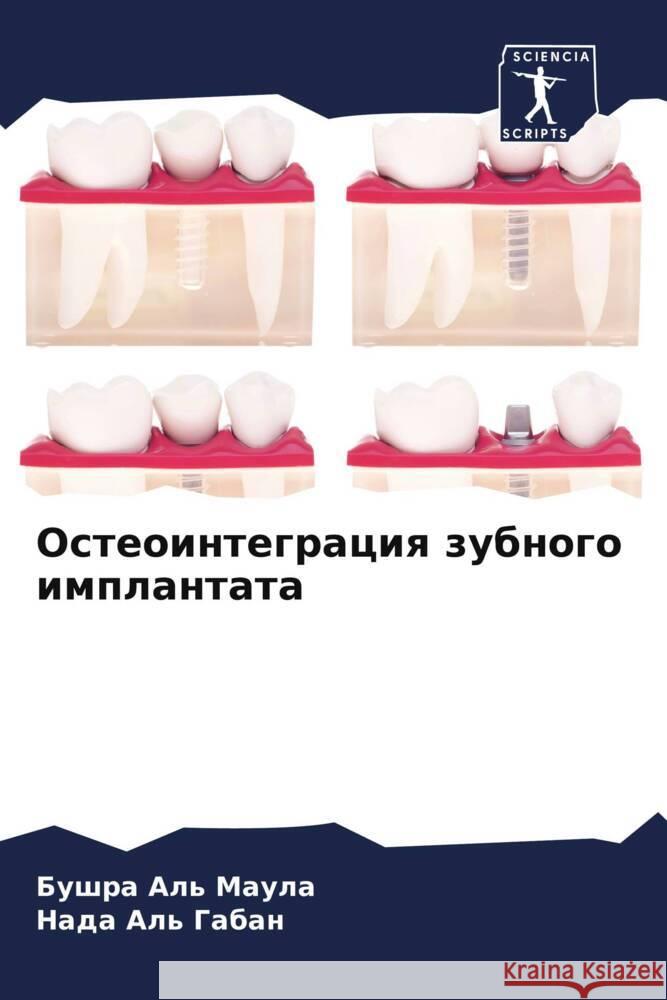 Osteointegraciq zubnogo implantata Al' Maula, Bushra, Al' Gaban, Nada 9786208060619