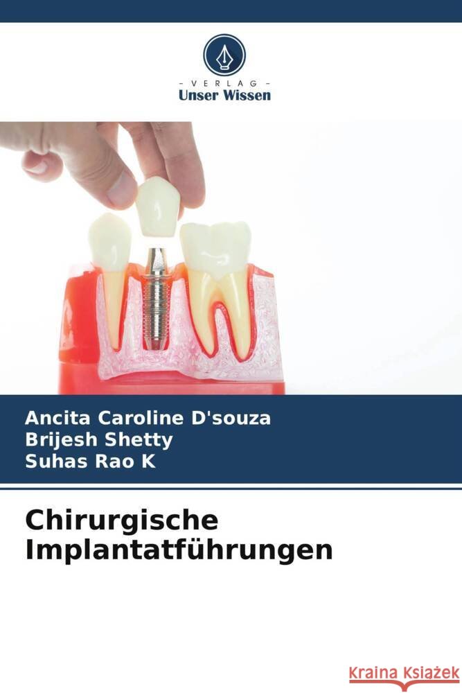 Chirurgische Implantatf?hrungen Ancita Caroline D'Souza Brijesh Shetty Suhas Rao K 9786208075590 Verlag Unser Wissen