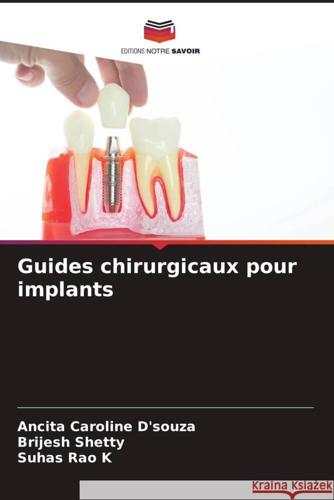 Guides chirurgicaux pour implants Ancita Caroline D'Souza Brijesh Shetty Suhas Rao K 9786208075675