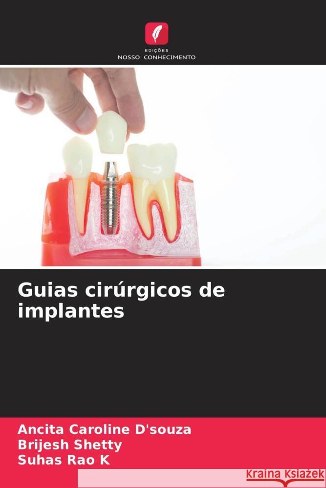 Guias cir?rgicos de implantes Ancita Caroline D'Souza Brijesh Shetty Suhas Rao K 9786208075712 Edicoes Nosso Conhecimento