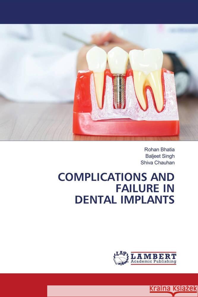 COMPLICATIONS AND FAILURE IN DENTAL IMPLANTS Bhatia, Rohan, Singh, Baljeet, Chauhan, Shiva 9786208117184