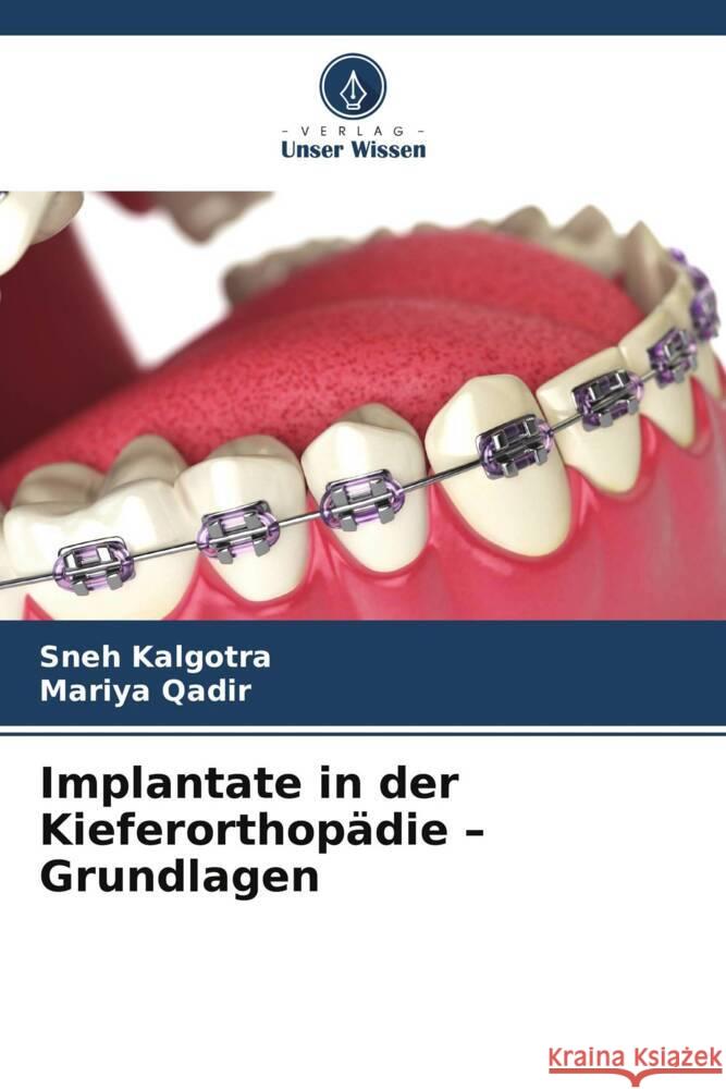 Implantate in der Kieferorthop?die - Grundlagen Sneh Kalgotra Mariya Qadir 9786208131104 Verlag Unser Wissen