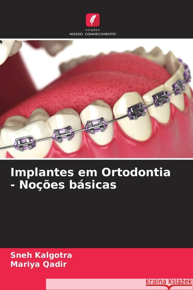 Implantes em Ortodontia - No??es b?sicas Sneh Kalgotra Mariya Qadir 9786208131159