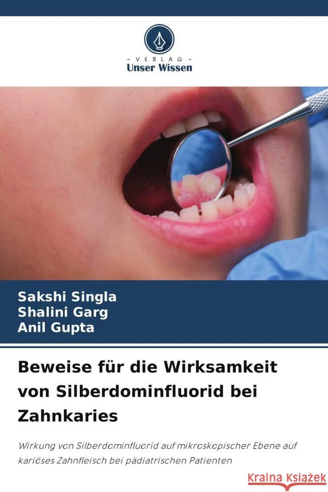 Beweise f?r die Wirksamkeit von Silberdominfluorid bei Zahnkaries Sakshi Singla Shalini Garg Anil Gupta 9786208153717