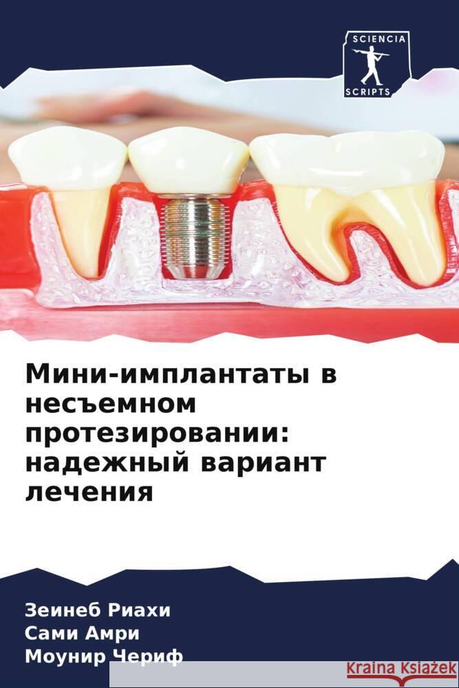 Mini-implantaty w nes#emnom protezirowanii: nadezhnyj wariant lecheniq Riahi, Zeineb, Amri, Sami, Cherif, Mounir 9786208159290 Sciencia Scripts