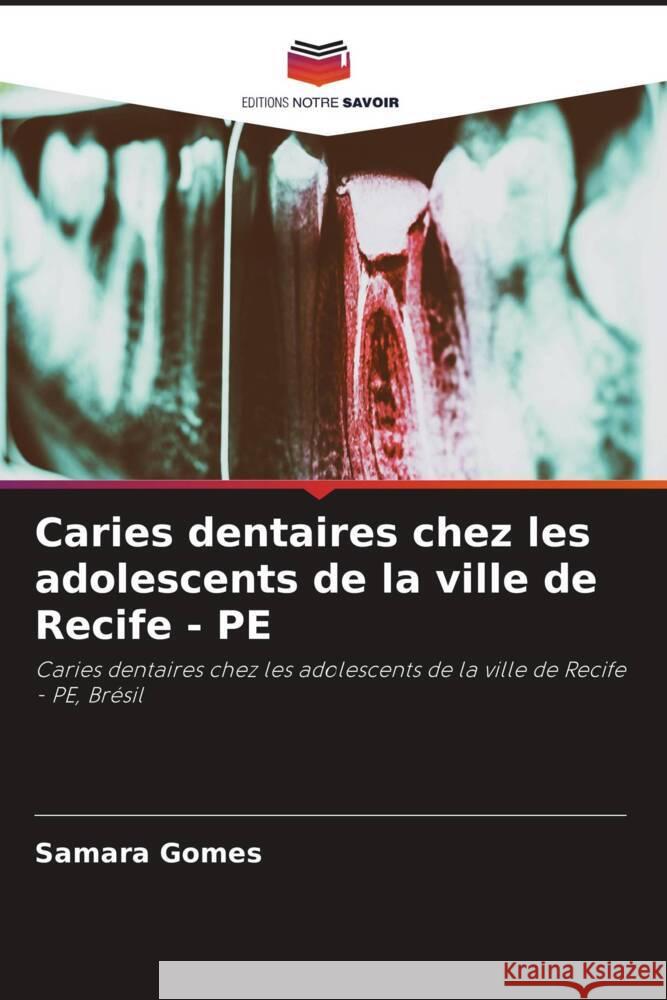 Caries dentaires chez les adolescents de la ville de Recife - PE Samara Gomes 9786208163907