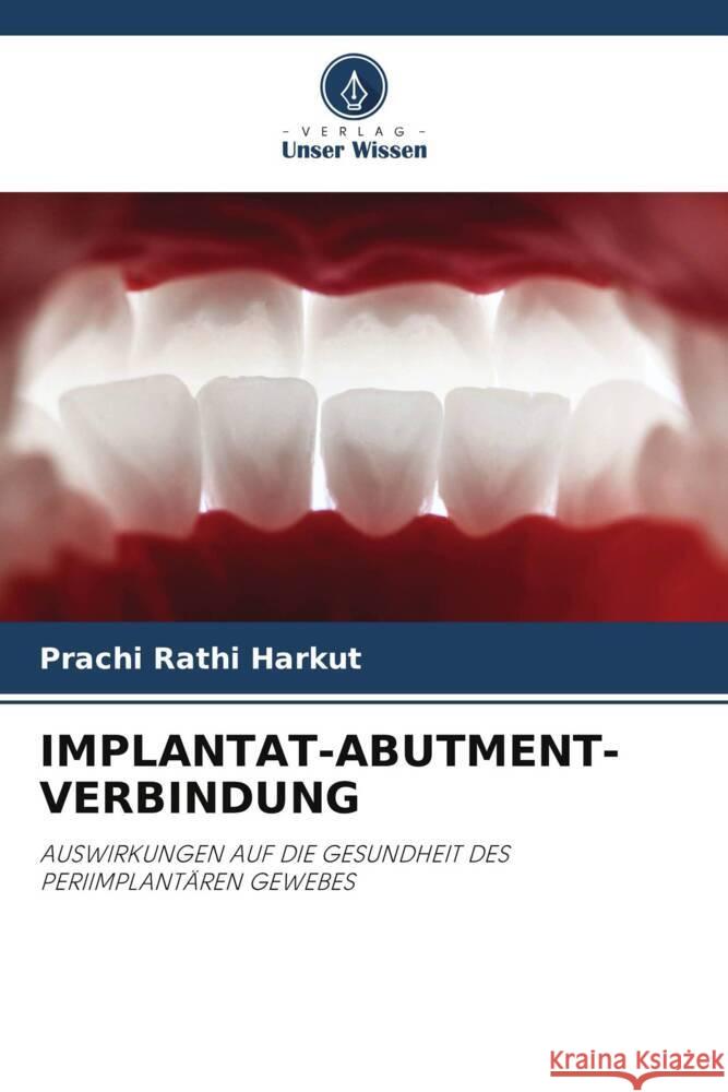 IMPLANTAT-ABUTMENT-VERBINDUNG Rathi Harkut, Prachi 9786208174279