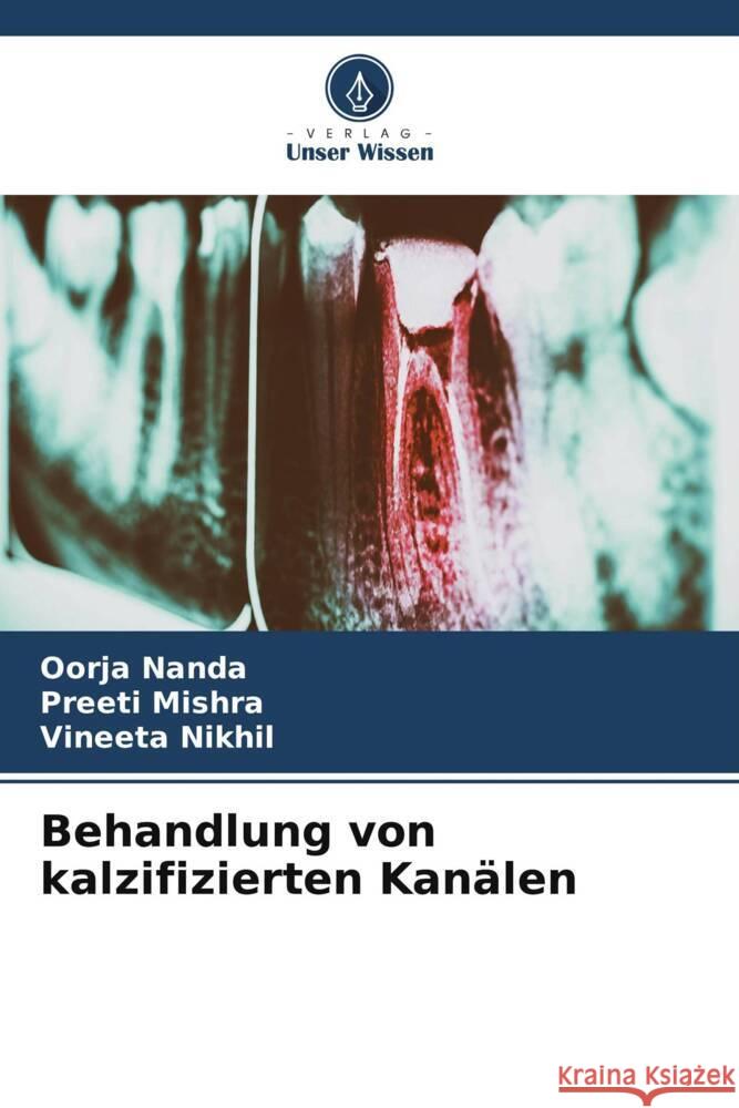 Behandlung von kalzifizierten Kanälen Nanda, Oorja, Mishra, Preeti, Nikhil, Vineeta 9786208197438