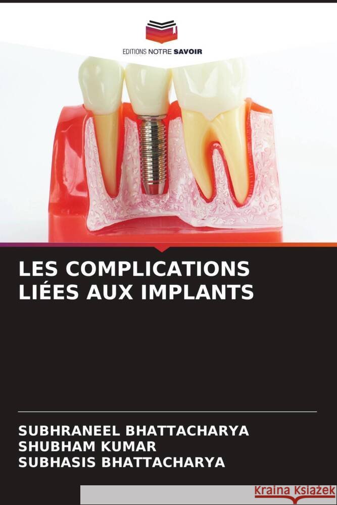 LES COMPLICATIONS LIÉES AUX IMPLANTS BHATTACHARYA, SUBHRANEEL, Kumar, Shubham, Bhattacharya, Subhasis 9786208198954 Editions Notre Savoir