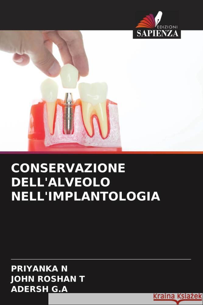 CONSERVAZIONE DELL'ALVEOLO NELL'IMPLANTOLOGIA N, PRIYANKA, Roshan T, John, G.A, Adersh 9786208230821