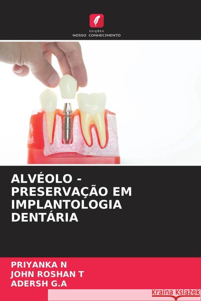 ALVÉOLO - PRESERVAÇÃO EM IMPLANTOLOGIA DENTÁRIA N, PRIYANKA, Roshan T, John, G.A, Adersh 9786208230852