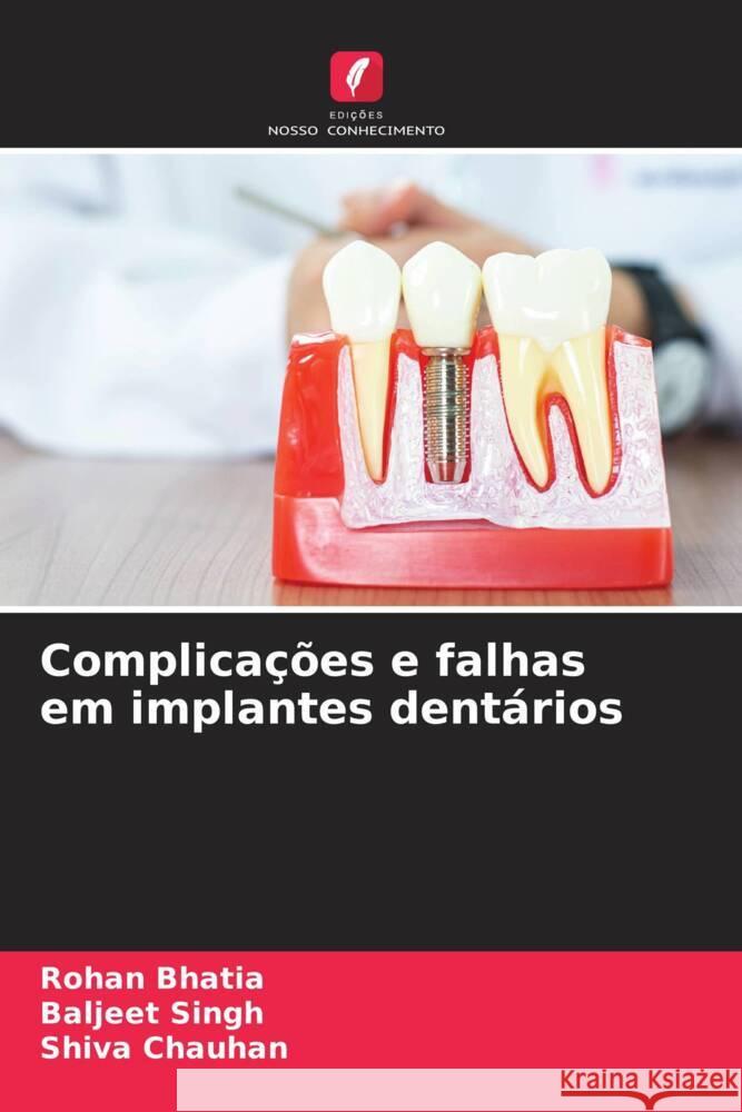 Complicações e falhas em implantes dentários Bhatia, Rohan, Singh, Baljeet, Chauhan, Shiva 9786208232665