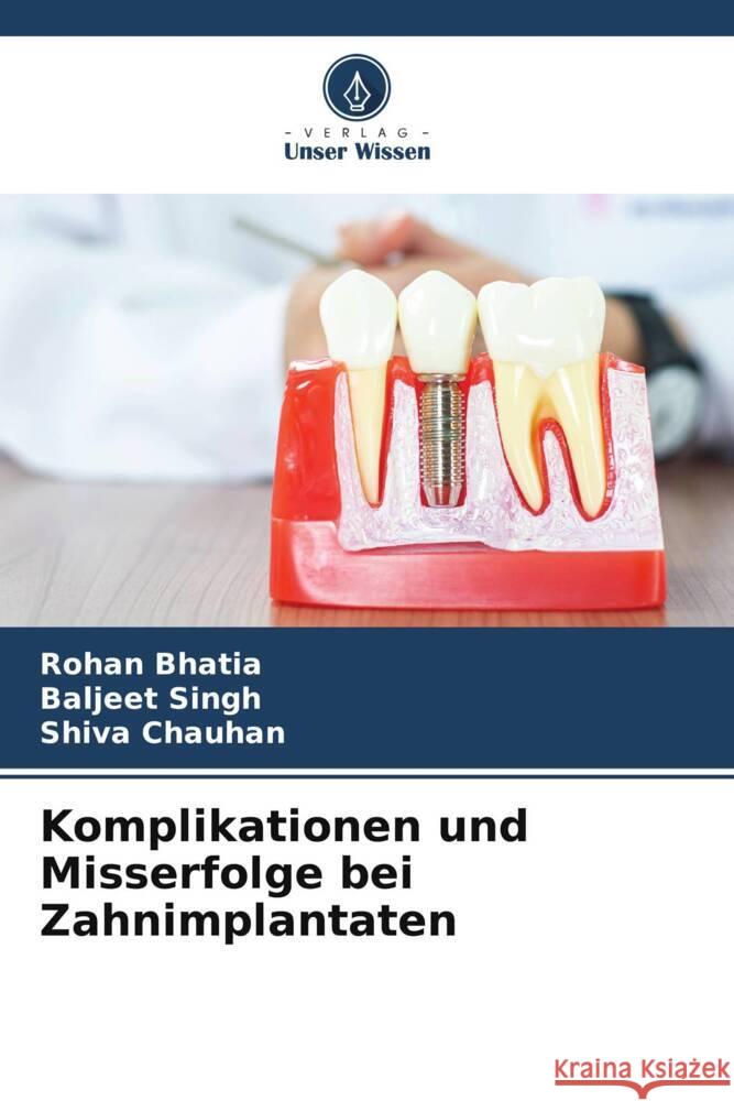 Komplikationen und Misserfolge bei Zahnimplantaten Bhatia, Rohan, Singh, Baljeet, Chauhan, Shiva 9786208232702