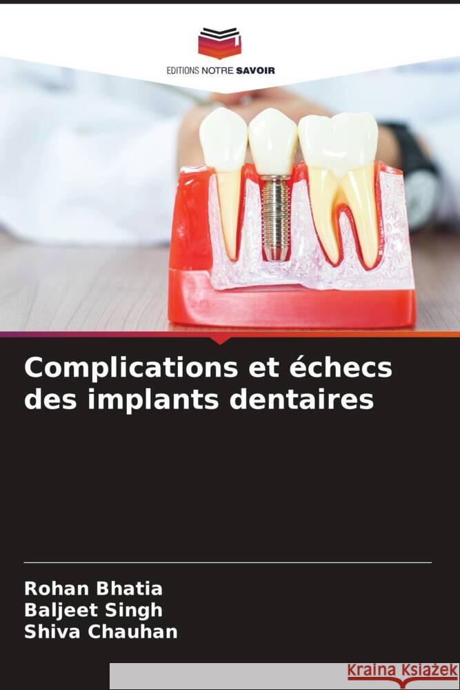 Complications et échecs des implants dentaires Bhatia, Rohan, Singh, Baljeet, Chauhan, Shiva 9786208232757