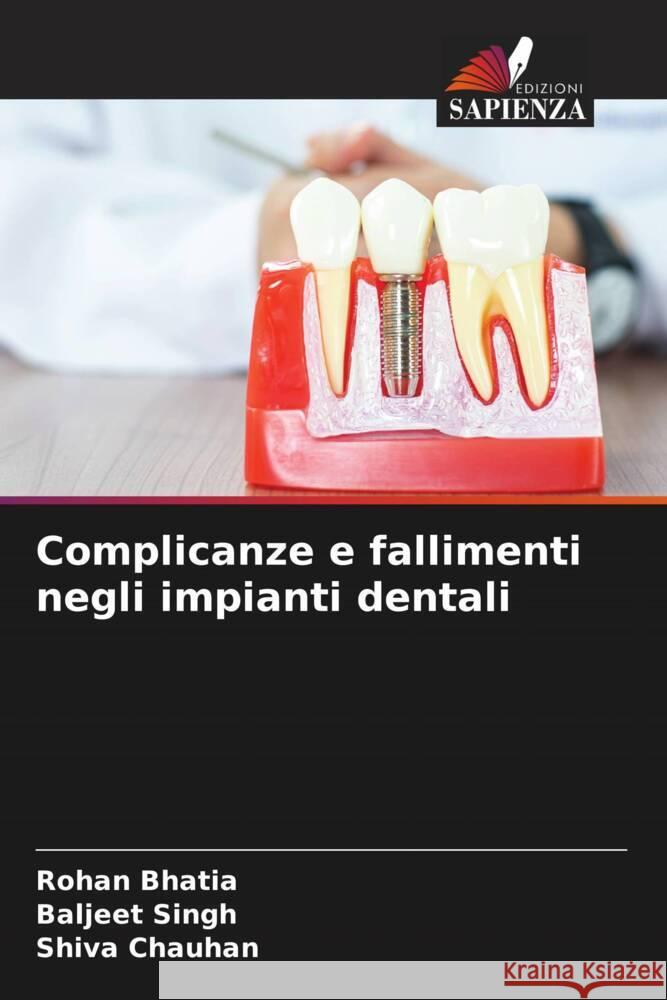 Complicanze e fallimenti negli impianti dentali Bhatia, Rohan, Singh, Baljeet, Chauhan, Shiva 9786208232764