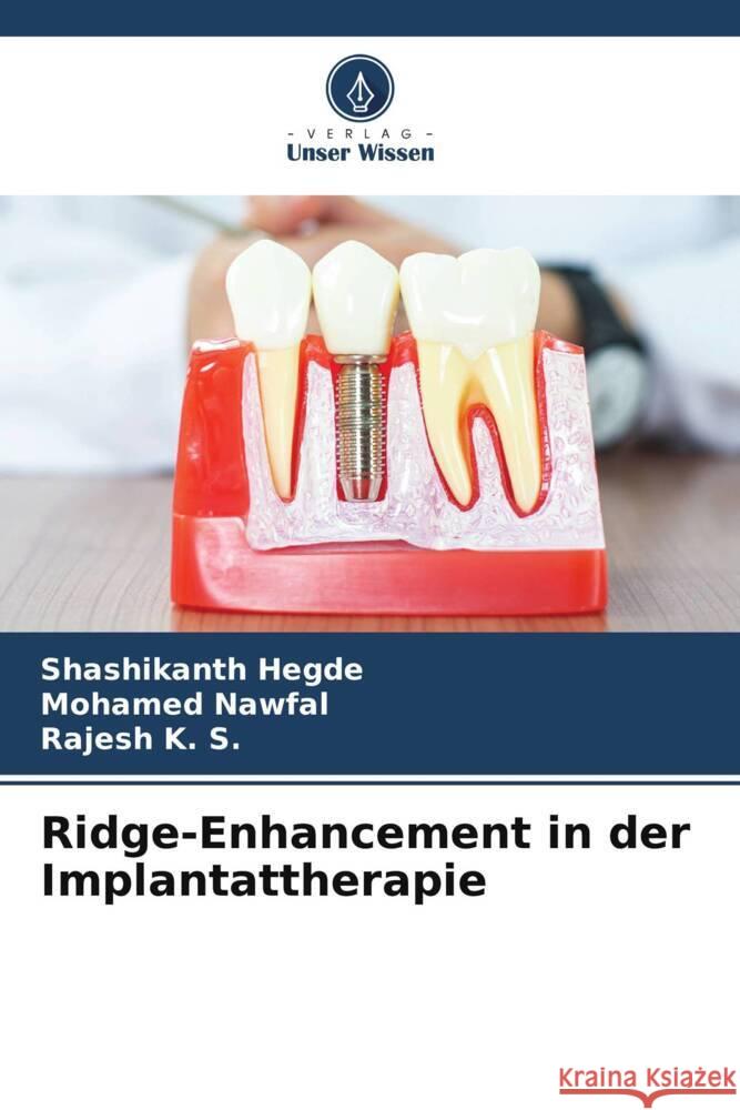 Ridge-Enhancement in der Implantattherapie Hegde, Shashikanth, NAWFAL, MOHAMED, K. S., Rajesh 9786208292942