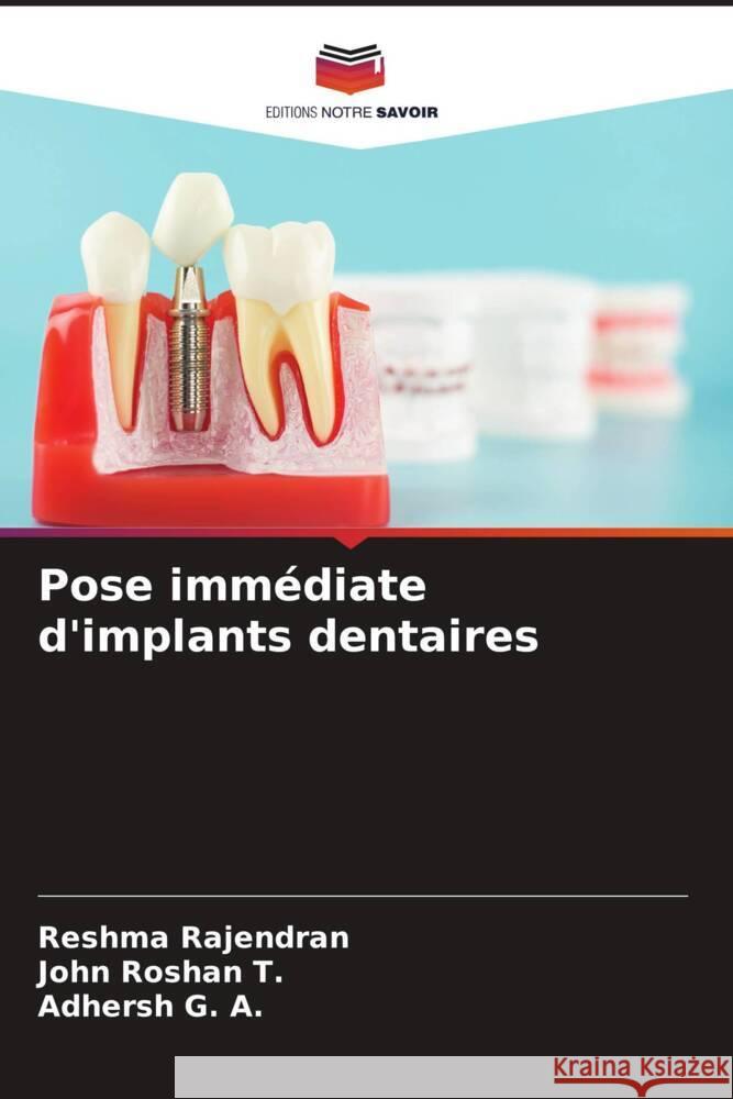 Pose immédiate d'implants dentaires Rajendran, Reshma, Roshan  T., John, G. A., Adhersh 9786208299811 Editions Notre Savoir