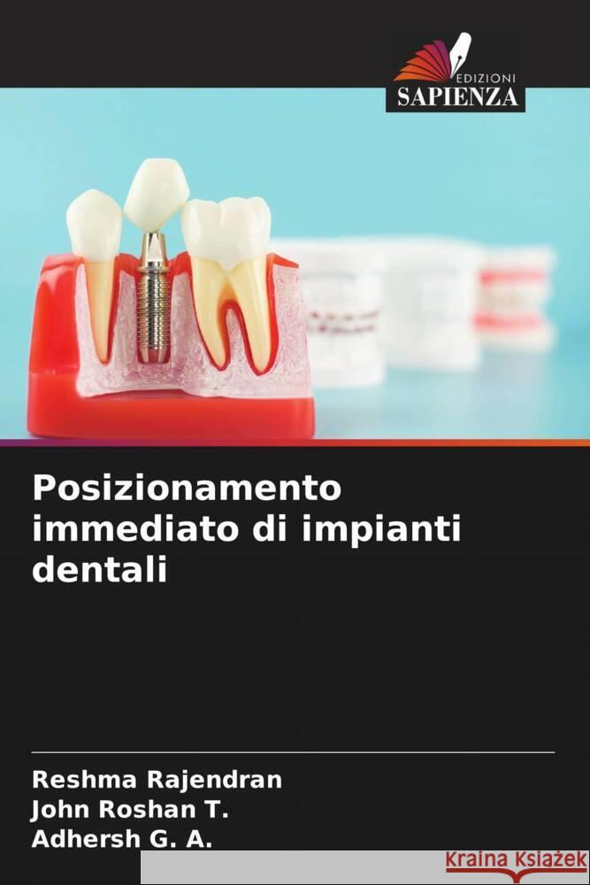 Posizionamento immediato di impianti dentali Rajendran, Reshma, Roshan  T., John, G. A., Adhersh 9786208299828 Edizioni Sapienza