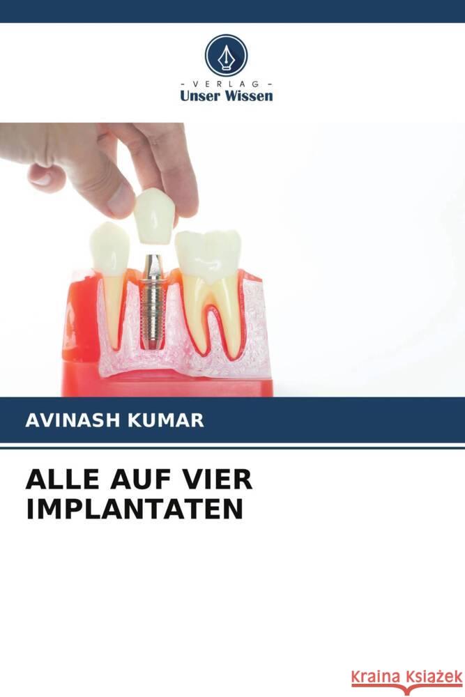 ALLE AUF VIER IMPLANTATEN Kumar, Avinash 9786208300401