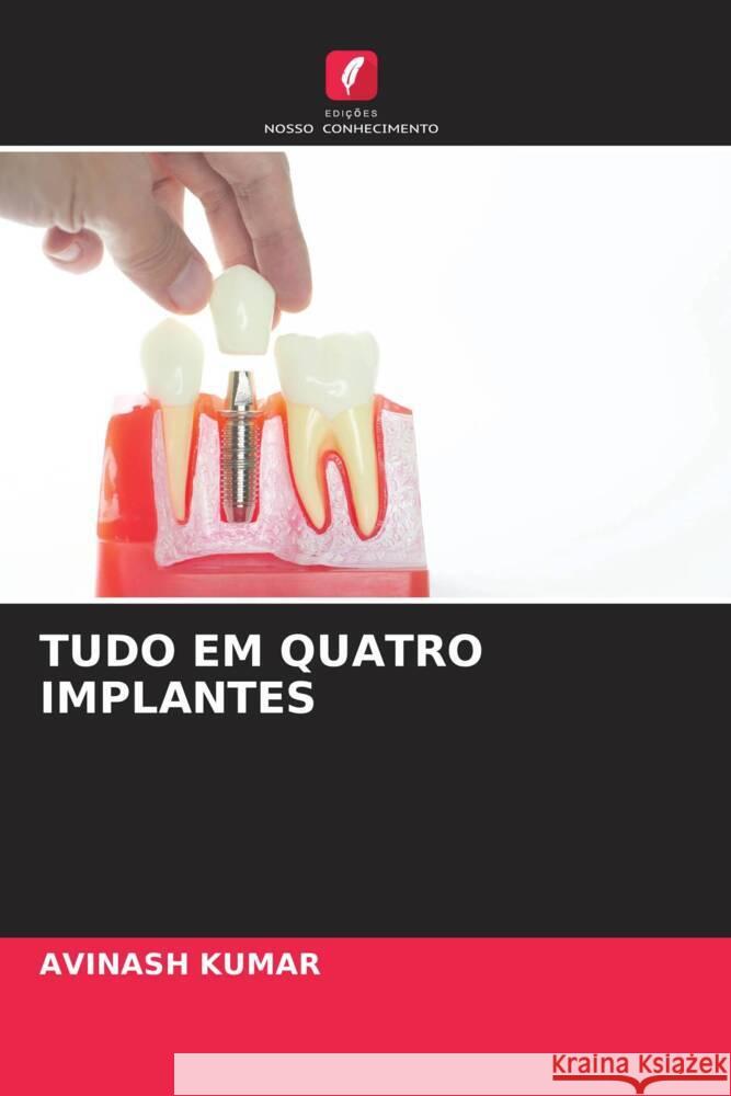 TUDO EM QUATRO IMPLANTES Kumar, Avinash 9786208300425