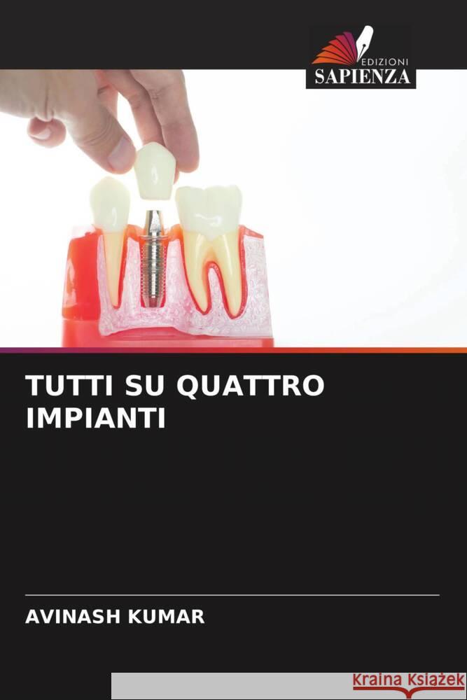 TUTTI SU QUATTRO IMPIANTI Kumar, Avinash 9786208300432